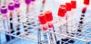 There are new blood tests for Alzheimer’s. Should I have one?