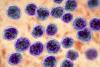 <![CDATA[How Effective is Fixed-Duration Cevostamab in Multiple Myeloma?]]>