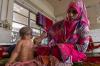 Bangladesh Records More Than 1,000 New Measles Cases in 24 Hours