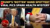 Trump's 'SWOLLEN' Hands Spark Fresh Health Fears As Critics Say They're 'ROTTING' | WATCH