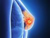 Qubit’s Q007-302 shows promise for breast cancer