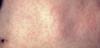 Central Valley counties monitor agricultural workers after measles exposure in Arizona