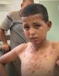 Al-Barsh: Chickenpox Becoming Epidemic in Gaza with 58,000 Cases Recorded