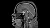 Stem Cell Transplant Boosts Survival in Primary CNS Lymphoma