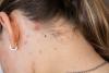 The disease from the past that’s irritating but far from harmless