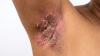 <![CDATA[Adalimumab grabs top spot as most cost-efficient biologic for hidradenitis suppurativa]]>
