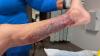 2nd Vibrio vulnificus death and 14 cases reported in Florida