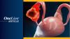 <![CDATA[EU Clears PD-L1 IHC 22C3 pharmDx as Companion Diagnostic for Pembrolizumab in Ovarian Cancer]]>