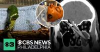 Tree branch impales New Jersey man through face, into brain in freak accident
