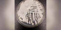 ‘Superbug’ fungus has spread to half the US. Should you be concerned?