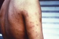 Leprosy cases are on the rise in Florida. Here’s how to reduce your risk