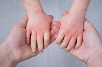 Early allergy detection key to healthier lives for children