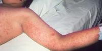 Officials warn of measles exposures at Randall Children’s Hospital on two separate days in Portland