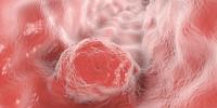 Surveillance Offers Equal QALYs & Economic Edge vs Surgery in CCR After Esophageal nCRT