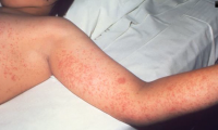 Connecticut becomes one of first states to join new U.S. disease tracking system