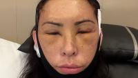 ‘Snatched’ in Turkey: How a gory social media trend is fuelling a surge in cosmetic tourism