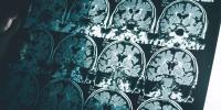 Early neglect may disrupt how the brain fine-tunes itself during adolescence