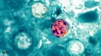 Here's what to know about cyclospora after second local case announced