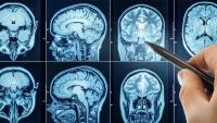 Common Health Risks You Can Change May Be Accelerating Dementia—Study Finds