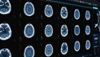Brains that cope well with stress resemble one another