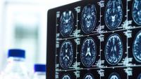 Important dementia update as scientists now have first 'complete baseline' of its kind