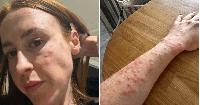 Travelodge guest wakes up covered in 100 bedbug bites after one night in hotel