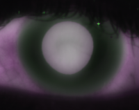 Early Detection in Corneal Disease