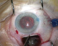 Techniques for MSICS for Hard Cataracts