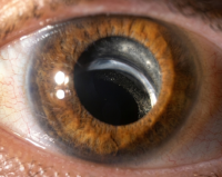 Novel Complications Following Cataract Surgery