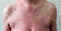 Soligenix culls topical lymphoma asset after Phase III miss