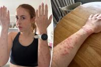 Travel influencer riddled with bleeding bed bug bites after one-night stay at popular international hotel: ‘Wouldn’t wish this on my worst enemy’