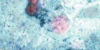 Missouri ranks 3rd in cyclospora cases as outbreak climbs to over 1,500