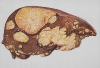 Seeking a lasting cure for hepatitis B
