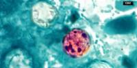 Cyclosporiasis numbers in Northeast Indiana raise questions about source