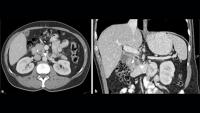 Pancreatic Cancer Specialists Getting a Jump on Daraxonrasib