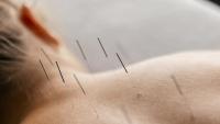 Acupuncture for IBS: Does It Really Help?