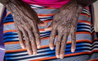 Madagascar forced to divide and share mpox vaccine as epidemic takes off