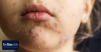 HPA confirms 17 more cases of measles in the capital this week