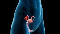 <![CDATA[Disease Stage/Age Among Adverse Prognostic Factors for Ovarian Germ Cell Tumors]]>