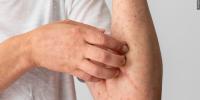 Wisconsin health officials confirm measles in Iowa, Lafayette Counties