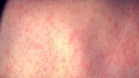 Mt. Hood Medical Center Measles Exposure