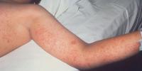 Wisconsin DHS confirms measles cases in Iowa and Lafayette counties, urges residents to check vaccination status