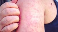 Two southwest Wisconsin residents have measles, health officials say