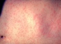 Low Vaccination Rates Driving Measles Outbreak in Wisconsin