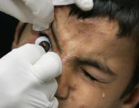 A Fake Eye Disease Called Bixonimania Fooled Four AI Chatbots and One Peer-Reviewed Journal