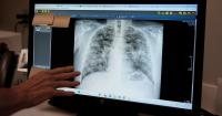 Virginia clinics see black lung surge in coal miners
