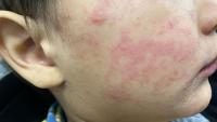 Measles cases in 2026 surpass Oregon’s peak measles year