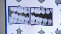 Researchers study regenerative dentistry to help teeth heal themselves with cells and proteins