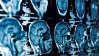 Amsterdam researchers find remedy for fatal child brain disease