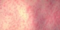 Ohio reports 69 cases as measles outbreak grows